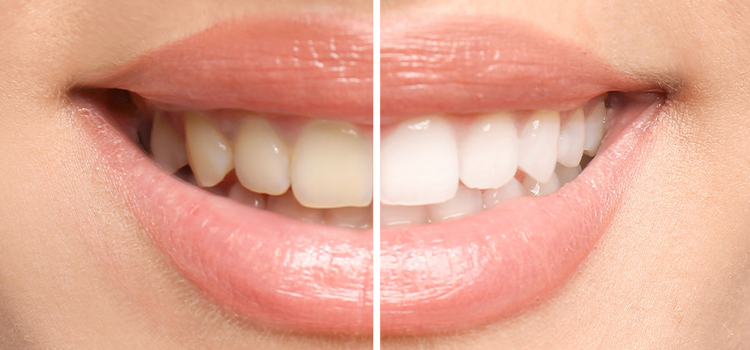 A side by side comparison of unwhitened teeth and whitened teeth